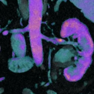 Urothelial mass