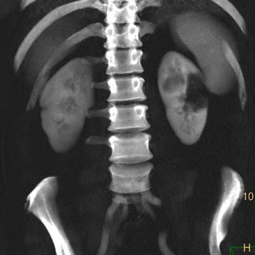 Spontaneous renal artery dissection