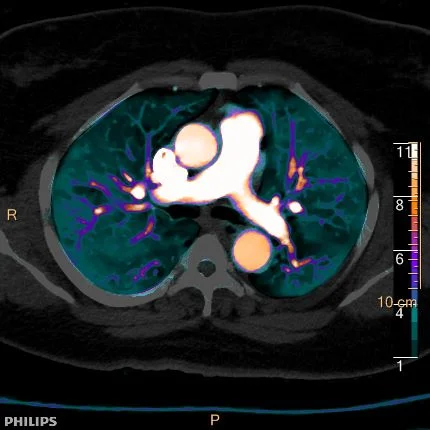 About spectral CT — Spectral CT