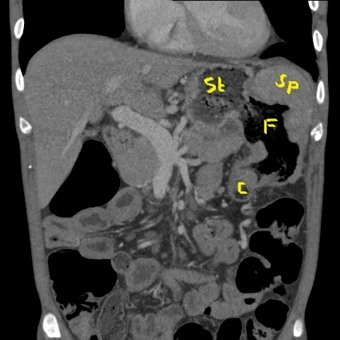 Conventional CT (coronal image) shows fistula (F) between the stomach (St), spleen (Sp) and colon (C)