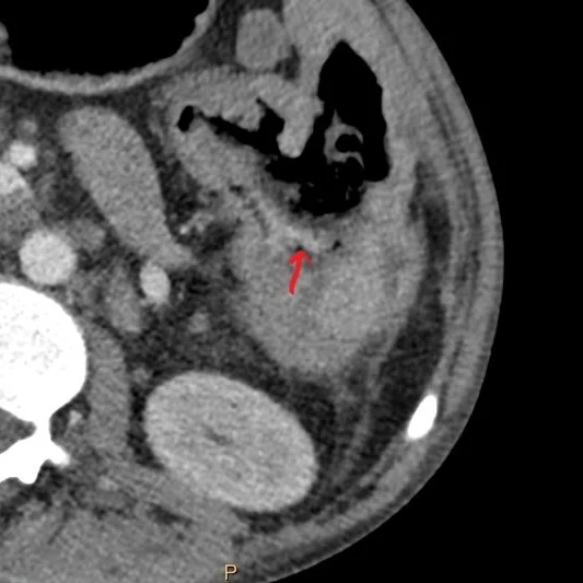 Conventional CT (axial plane) shows ill-defined density (red arrow) in the posterior aspect of fistula
