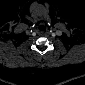 Conventional CT with poor enhancement