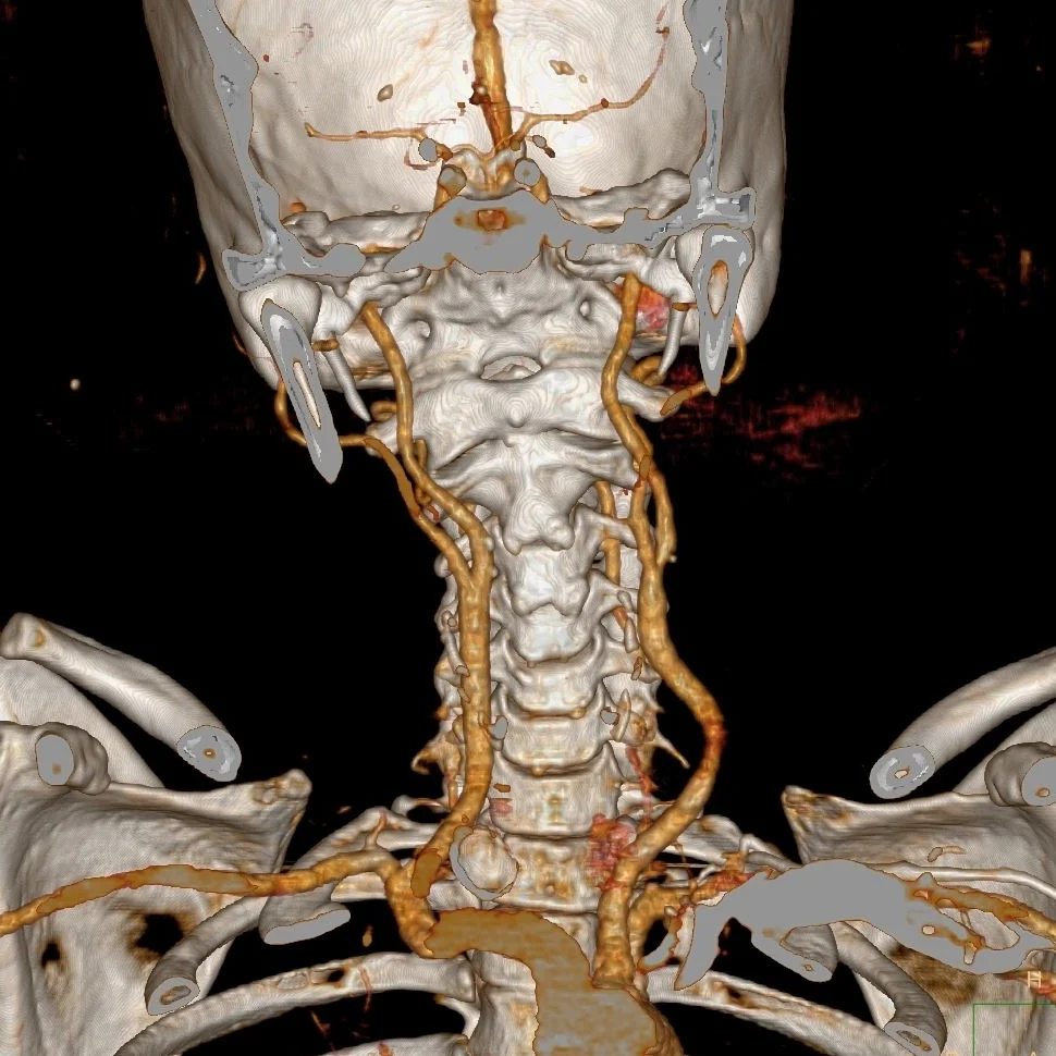 Low contrast dose neck CTA