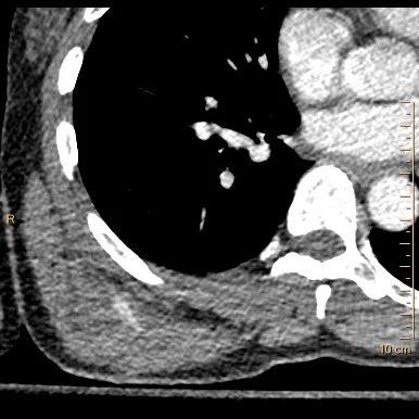 Conventional CT with subtle hyperdensity inferior to the right scapula in the back