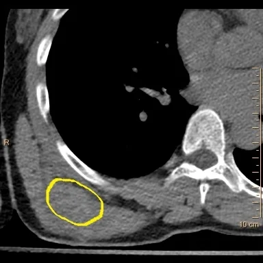 Absence of density on virtual non-contrast confirms contrast extravasation