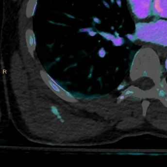 Stab wound with active extravasation