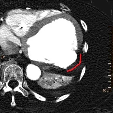 Iodine map shows large thrombus in the aneurysm with absent iodine uptake (red curve)