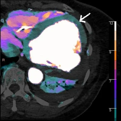 Iodine overlay image. Note normal LV wall perfusion (white arrow), color is absent in the aneurysm.