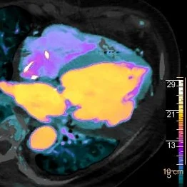LV aneurysm with thrombus