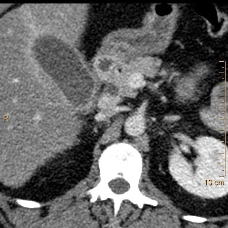 Conventional CT shows inflammatory changes around the gallbladder, but NO gallstone