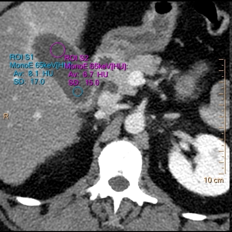ROI placed over expected location of gallstone (blue) and bile (magenta) on convantional CT show nearly identical density (8.1 vs 6.7 HU)