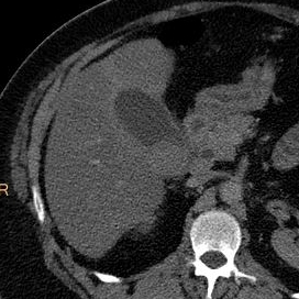 Gallstone seen as positive density on 200 keV image