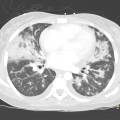 Conventional CT (lung windows) 