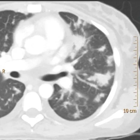 Infiltrates in left lung have "flame shaped" appearance