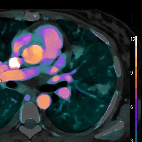 A case of a lung infiltrates