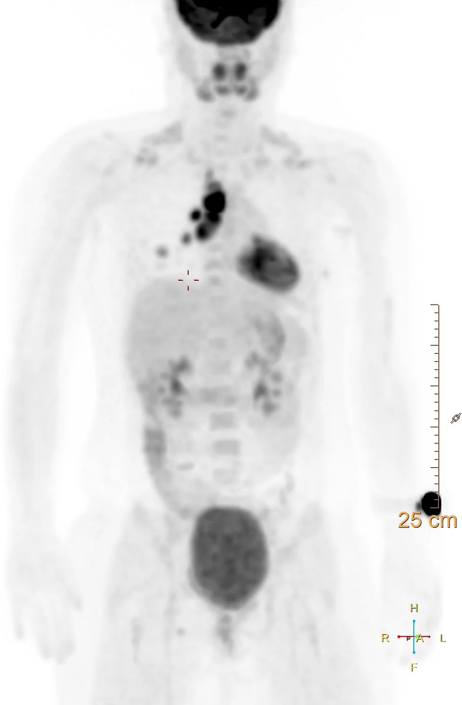 intense FDG uptake in mediastinal lymph nodes and lung opacity.