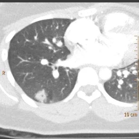Conventional CT with pleural based opacity in right lung. Astute obervers will notice small cavitation.