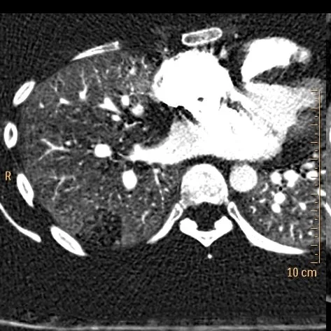 Notice focal hypoperfusion in the lung opacity and adjacent air-trapping.