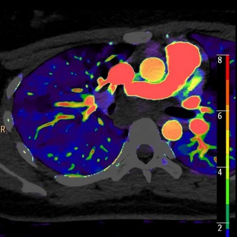 Large subcarinal lymph node with decreased perfusion, suggesting necrosis