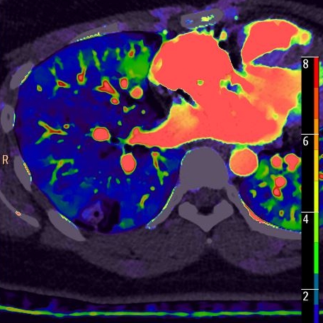 A case of focal infiltrate