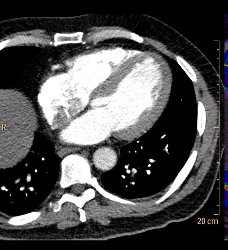 CT Chest PE shows normal appearing myocardial perfusion