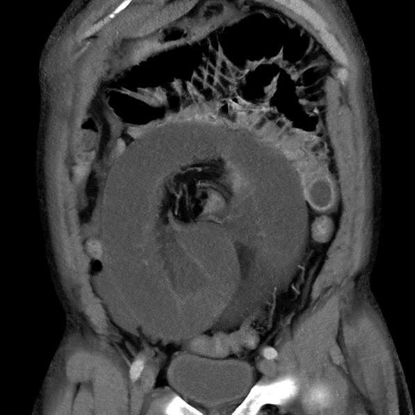 Oblique coronal image from conventional CT shows radial closed loop with mesenteric edema. Note the central "whirl".