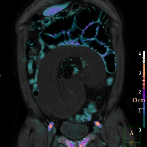 Fused image with iodine map shows absent iodine uptake in wall of dilated loop consistent with ischemia