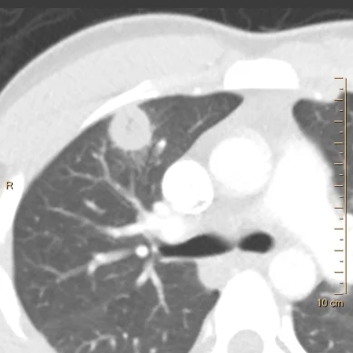 Conventional CT shows right upper lobe nodule with subtle cavitation