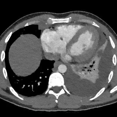 Note subtle vegetation adjacent to the tricuspid valve