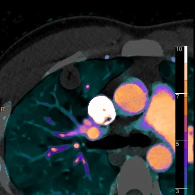 Pulmonary septic emboli
