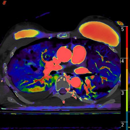 Fusion image nicely demonstrates the perfusion alterations.
