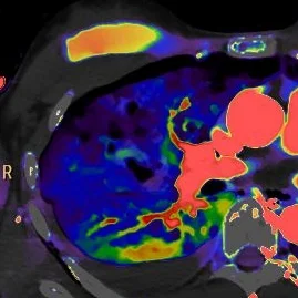 Lung injury: spectral insights