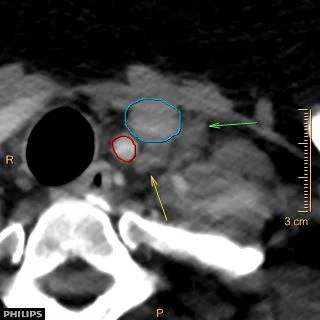 Conventional CT image. Note left internal jugular vein (blue circle) and left common carotid artery (the big red). Yellow arrow points to parathyroid adenoma, and green arrow to an adjacent lymph node; both look nearly identical