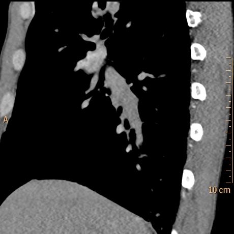 Conventional CT (oblique sagittal) shows normal appearing right lower lobe pulmonary artery