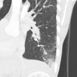 Oblique sagittal image lung windows shows infiltrate in the costophrenic angle with surrounding ground-glass opacity