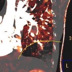 Iodine overlay image on CT PE study shows large perfusion defect in right lower lobe (outlined in yellow)