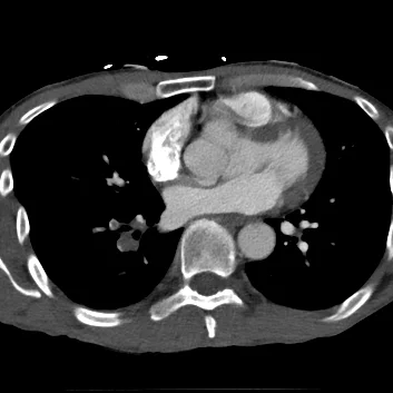 CT chest PE protocol confirms pulmonary embolism in right lower lobe