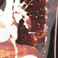 Iodine overlay image on CT Aorta shows the central core of decreased perfusion (outlined in yellow), and a peripheral zone of increased perfusion (outlined in blue). I beleive this is the penumbra.