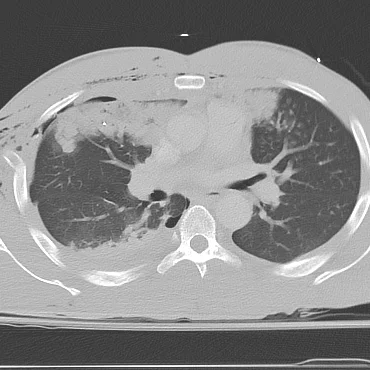 Bullet tract form left to the right in the anterior chest, somehow missing central vascular structures. Note punctate bullet fragments.