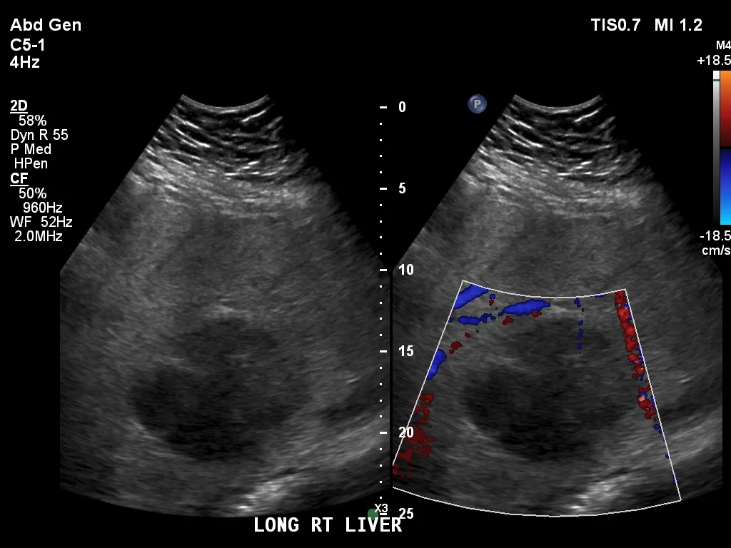 Ultrasound shows large hypoechoic liver lesion
