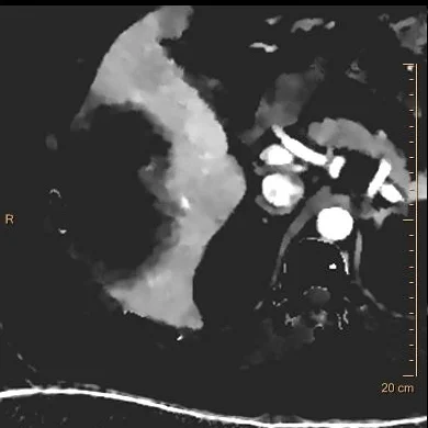 Iodine map shows liver lesion is a "black hole" except for a shaggy margin which shows low iodine uptake, this appearance is very suggestive of an abscess