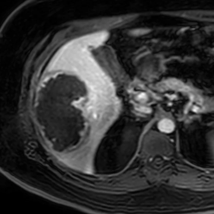 Post-contrast MRI reflects the findings on iodine map 