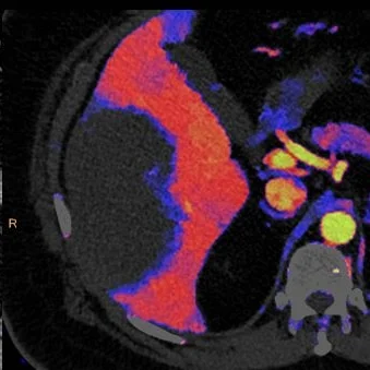 Liver abscess