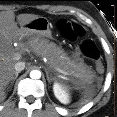 Conventional CT: changes of pancreatitis