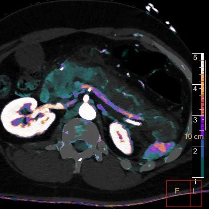 What about the pancreas?
