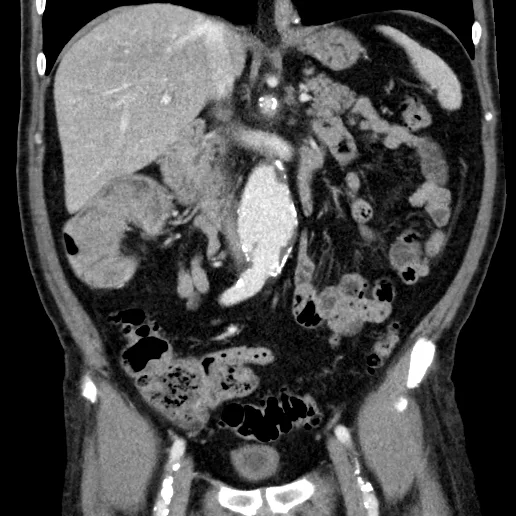 Conventional CT shows mass in cecum. Note incidental AAA.