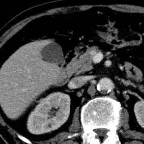 Axial image shows very subtle lesion in neck of the pancreas