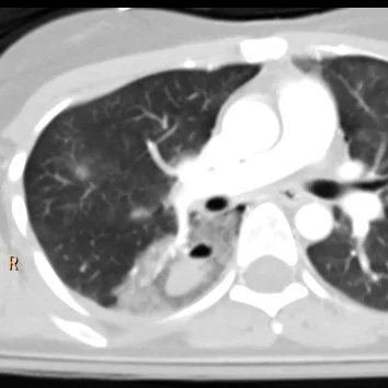 Conventional CT with typical "cavitary" lung laceration, and surrounding ground glass infiltrate consistent with lung contusion