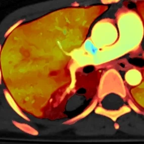 Lung laceration: spectral insight