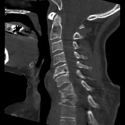 Cervical spine CT shows pathological fracture of C7 and T1